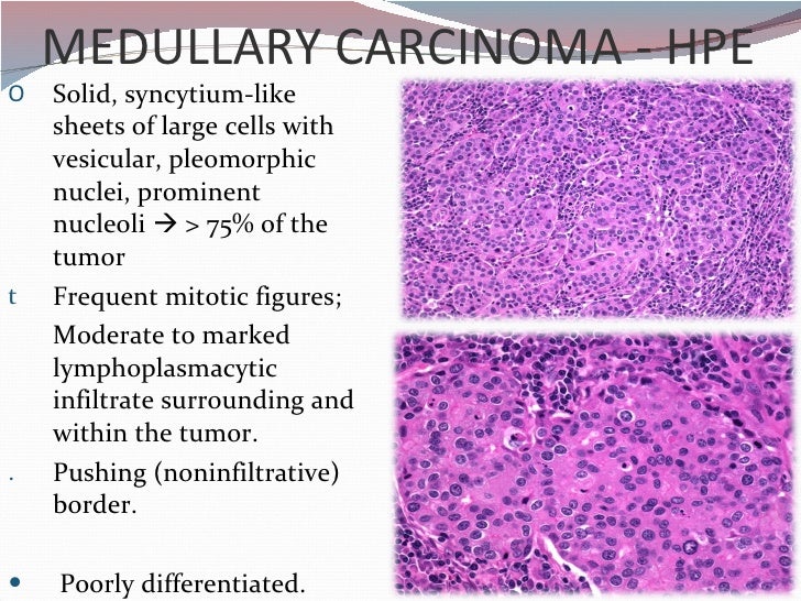 breast carcinoma medullary Breast carcinoma medullary